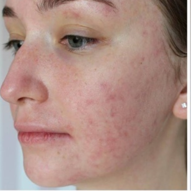 Lily before dermatica anti-ageing treatment