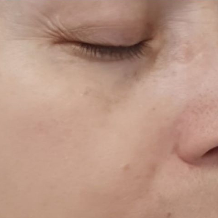 Lily after dermatica anti-ageing treatment