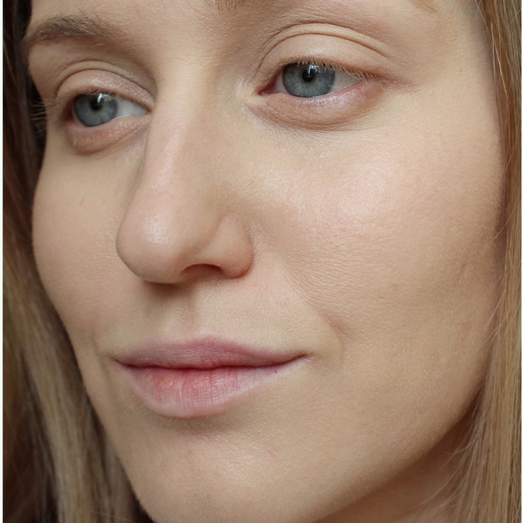 Lily after dermatica anti-ageing treatment