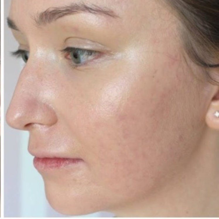 Lily after dermatica anti-ageing treatment